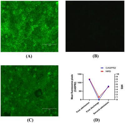 Case report: Recurring potassium channel complex autoimmunity-related neuropathic pain